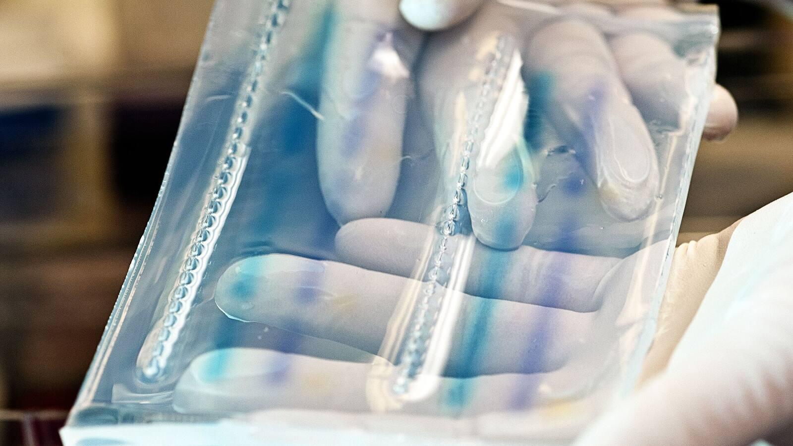 Agarose gel slab held in gloved hands after a DNA electrophoresis run, illustrating DNA damage analysis relevant to PARP1 and NAD+ consumption